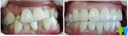 隱形牙齒矯正案例及前后對比照 隱形牙齒矯正案例及前后對比照