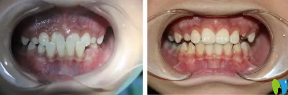 兒童地包天矯正案例及前后對(duì)比照 兒童地包天矯正案例及前后對(duì)比照