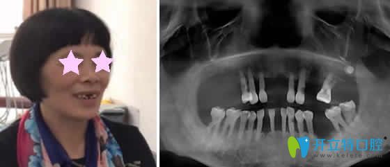 老媽在重慶華諾世口腔做即刻種植牙的個人經(jīng)歷分享