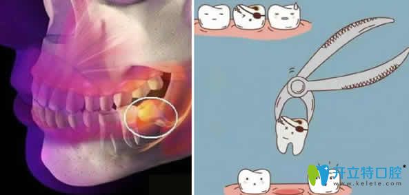 拔智齒后吃什么食物能恢復的快