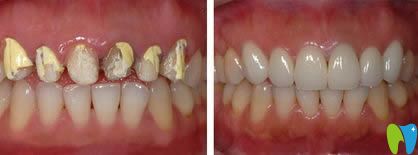 威海舒好口腔宋鵬烤瓷牙修復(fù)效果對(duì)比圖