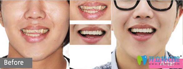 雷桂芳醫(yī)生前門牙修復前后對比案例