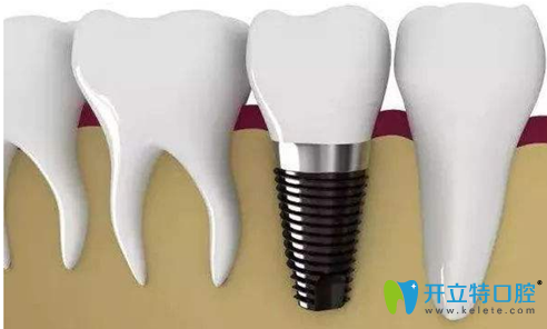 種牙用什么材料好？我是該選2千的，還是2萬(wàn)的？