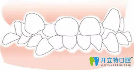 牙齒矯正可以做局部正畸嗎