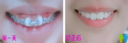 牙齒只有一兩顆不齊可以做半口矯正嗎？來看北京中諾口腔半口牙矯正真人案例