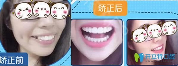 成都新橋口腔成人隱形牙齒矯正案例