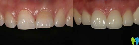 威海舒好口腔于英霞牙齒美容修復(fù)效果對(duì)比圖