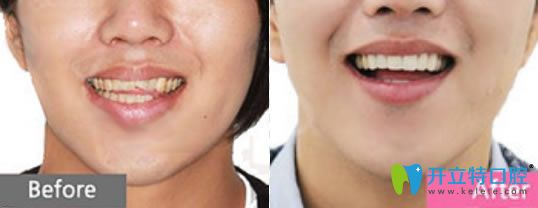 <!--<i data=20240703-sp></i>-->高安分醫(yī)生瓷貼面修復(fù)案例 <!--<i data=20240703-sp></i>-->高安分醫(yī)生瓷貼面修復(fù)案例