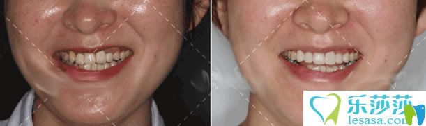 <!--<i data=20240703-sp></i>-->岳秀清醫(yī)生口腔修復(fù)案例對比圖 <!--<i data=20240703-sp></i>-->岳秀清醫(yī)生口腔修復(fù)案例對比圖
