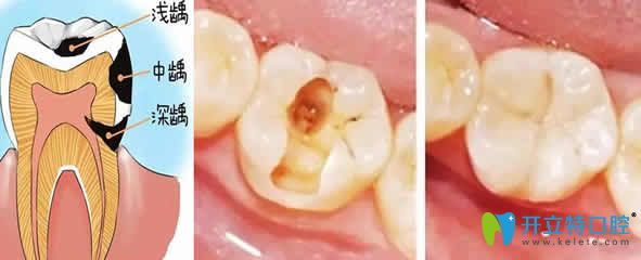 武漢優(yōu)益佳口腔張甘樂(lè)兒童齲齒治療效果圖