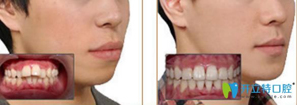 李智醫(yī)生齙牙矯正案例及臉型變化圖 李智醫(yī)生齙牙矯正案例及臉型變化圖