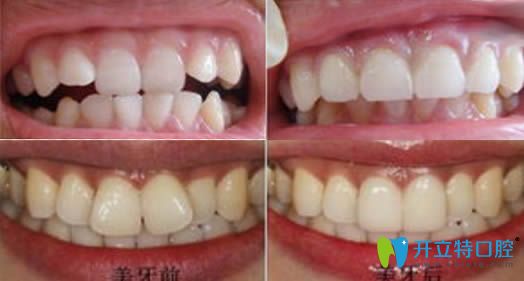 威海環(huán)翠區(qū)舒好口腔湯麗超牙齒正畸案例圖 威海環(huán)翠區(qū)舒好口腔湯麗超牙齒正畸案例圖