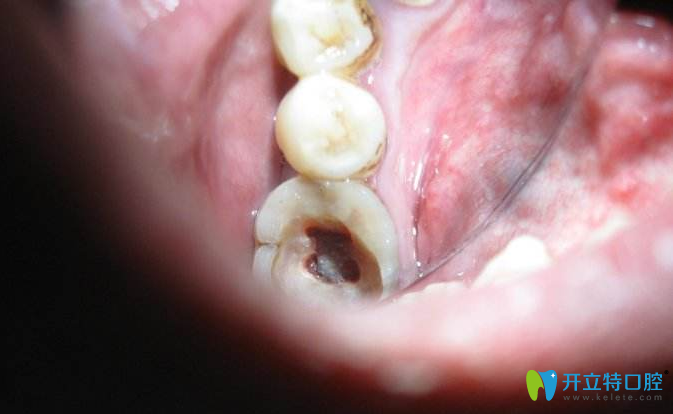 先給大家說說孩子什么情況下需要做根管治療