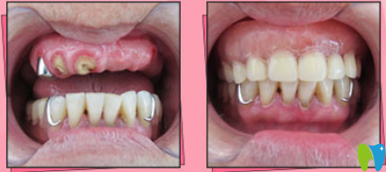 <!--<i data=20240703-sp></i>-->半口牙種植案例前后效果對(duì)比圖