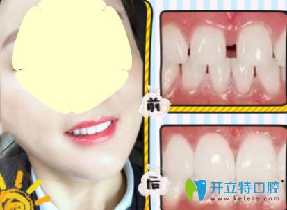 新橋口腔3D瓷貼面修復(fù)牙齒案例前后效果對(duì)