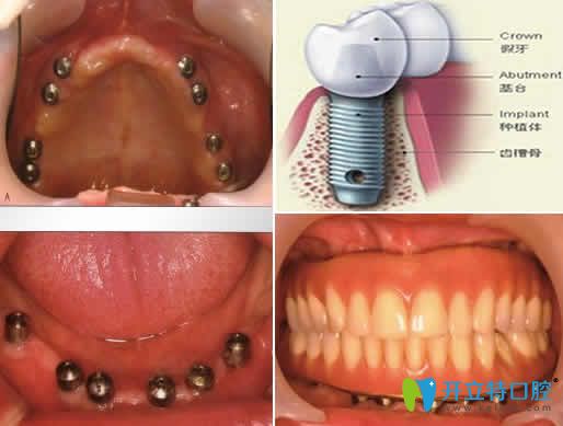 成都德頓齒科熊江全口種植牙效果圖