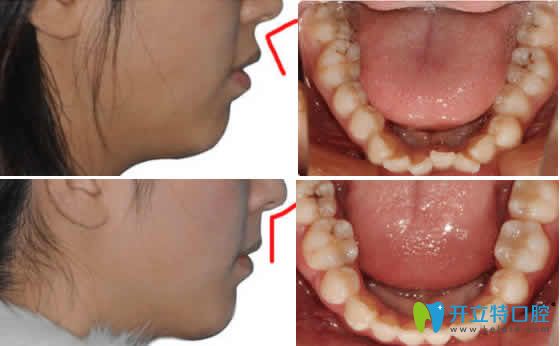 武漢優(yōu)益佳口腔楊高強隱形矯正案例效果圖 武漢優(yōu)益佳口腔楊高強隱形矯正案例效果圖