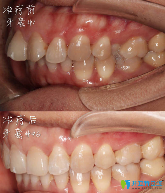 <!--<i data=20240703-sp></i>-->口腔正畸好不好？來(lái)看新橋口腔拔牙做隱形牙齒矯正案例