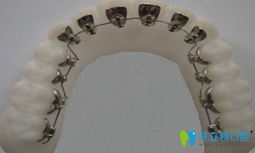 隱形舌側(cè)正畸