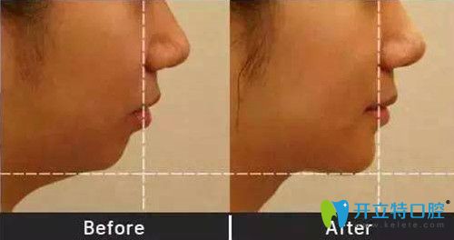 重慶齊美口腔矯正靠譜嗎？來(lái)看周映丞齙牙矯正真人案例前后效果對(duì)比圖