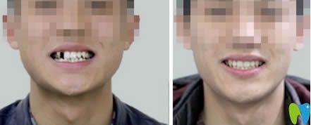 長(zhǎng)春超龍牙博士單顆牙缺失種植案例