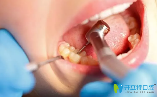 乳牙需要做根管治療嗎