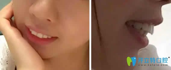 恭喜我在成都德頓齒科牙齒矯正710天牙套畢業(yè) 臉型變好看啦