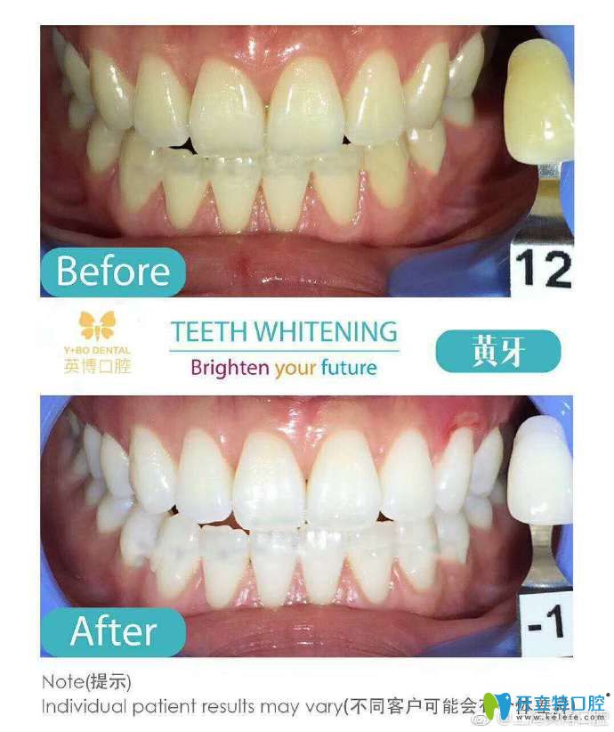 <!--<i data=20240703-sp></i>-->英博口腔韓主恩牙齒美白案例前后治療效果對(duì)比圖 <!--<i data=20240703-sp></i>-->英博口腔韓主恩牙齒美白案例前后治療效果對(duì)比圖