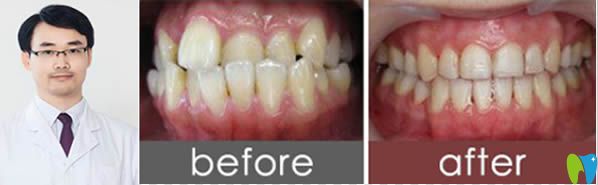 臺(tái)州維多利亞青少年地包天矯正前后對比照