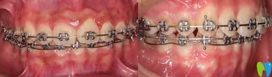 <!--<i data=20240703-sp></i>-->恒愿齒科牙齒矯正術(shù)中照
