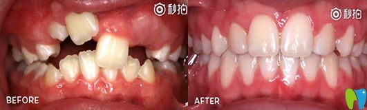 <!--<i data=20240703-sp></i>-->英博口腔王婷牙齒矯正案例 <!--<i data=20240703-sp></i>-->英博口腔王婷牙齒矯正案例