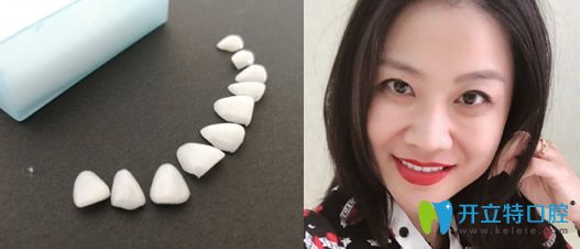 <!--<i data=20240703-sp></i>-->做DSD微笑美學(xué)磁貼面案例效果圖