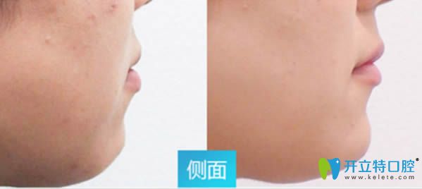 深覆蓋牙齒矯正案例及矯正后臉型變化