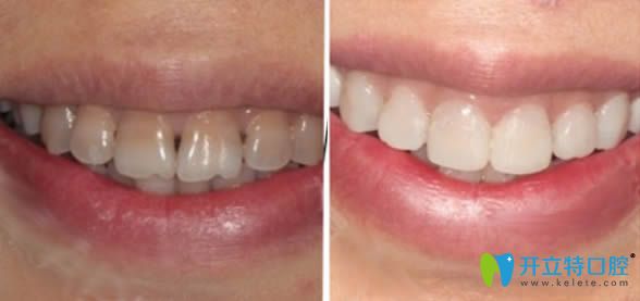 牙齒瓷貼面前后對比效果