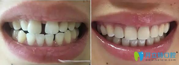 牙齒樹脂貼面修補(bǔ)牙縫案例對比圖
