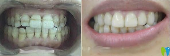 樹脂貼面6年后圖片