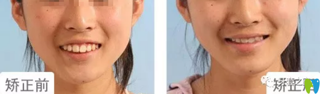 劉建林為14歲少女做齙牙矯正案例