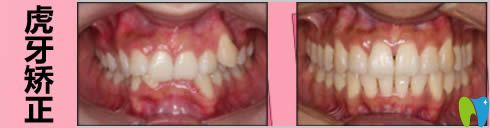 成人虎牙矯正案例及前后對比照