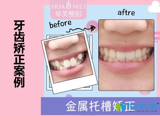汕頭華美口腔王宏偉醫(yī)生虎牙矯正案例及對(duì)比效果