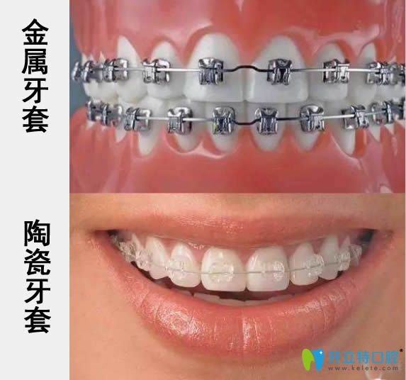 揭秘陶瓷和金屬牙套哪個(gè)好?通過價(jià)格及優(yōu)缺點(diǎn)來進(jìn)行大比拼