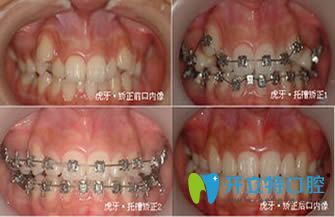 唇側矯正案例效果圖