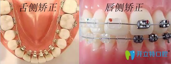 舌側矯正和唇側矯正對比圖片