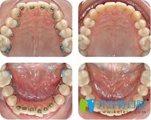 舌側矯正案例效果對比圖