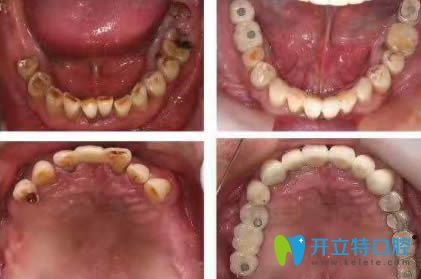 <!--<i data=20240703-sp></i>-->恒愿齒科劉奎恒愿速生牙效果對(duì)比圖