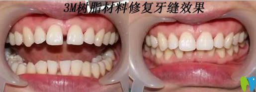 美國3M樹脂材料修復(fù)牙縫效果對比圖
