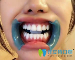 我在蘇州錦城口腔剛做完全瓷牙貼面的即刻照 我在蘇州錦城口腔剛做完全瓷牙貼面的即刻照