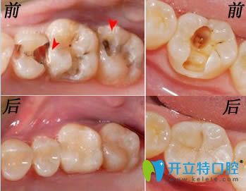 美國3M納米樹脂補牙效果對比圖
