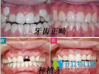蘇州錦誠口腔牙齒正畸和種植牙效果圖 蘇州錦誠口腔牙齒正畸和種植牙效果圖