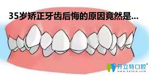 揭秘35歲拔牙矯正后悔死了的內幕及35歲矯正牙齒的利與弊