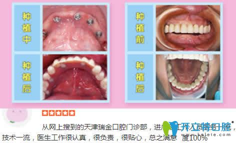 天津瑞金口腔種植牙<span style=